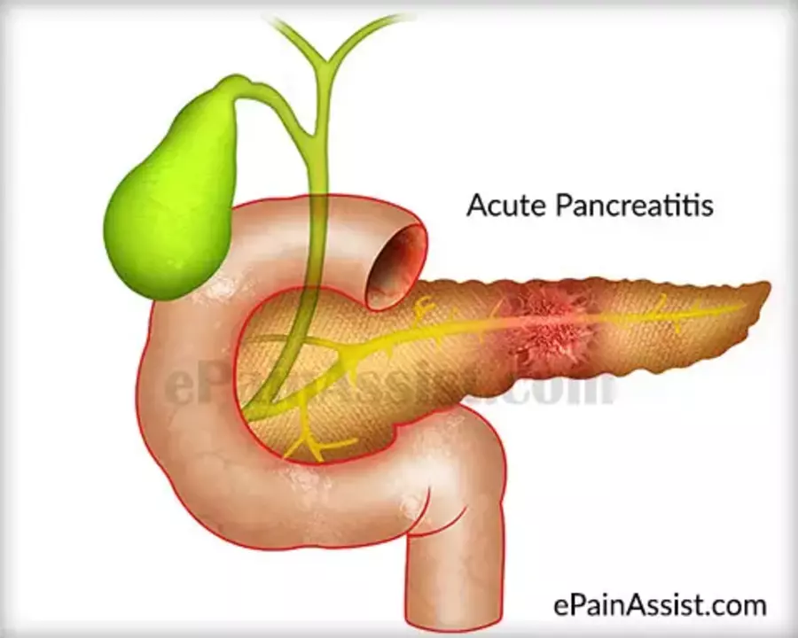 The link between severe stomach pain and pancreatitis