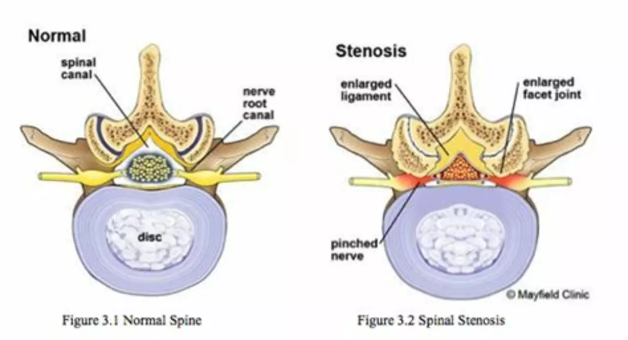 The potential benefits of Etodolac for managing pain associated with spinal stenosis